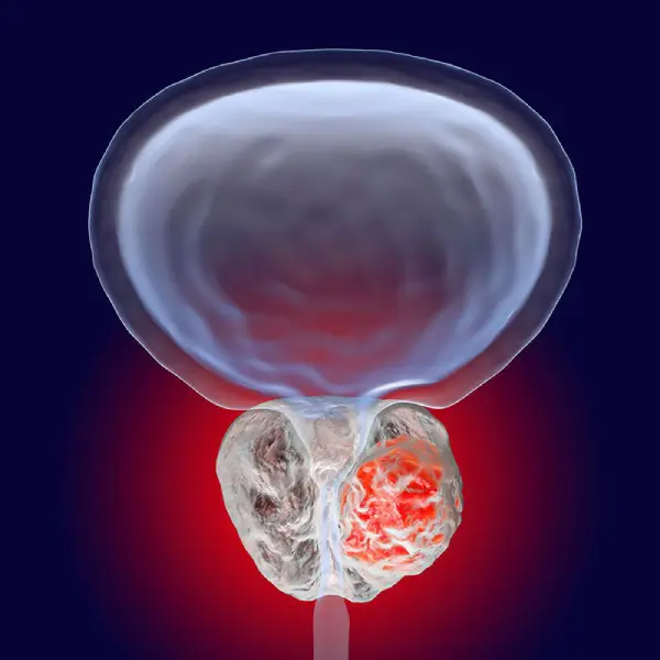 Illustrazione di una prostata infiammata